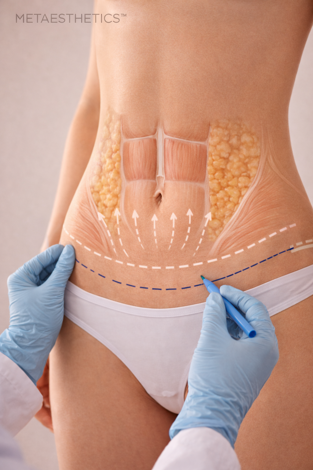 Abdominoplastie selon Metaesthetics en Suisse